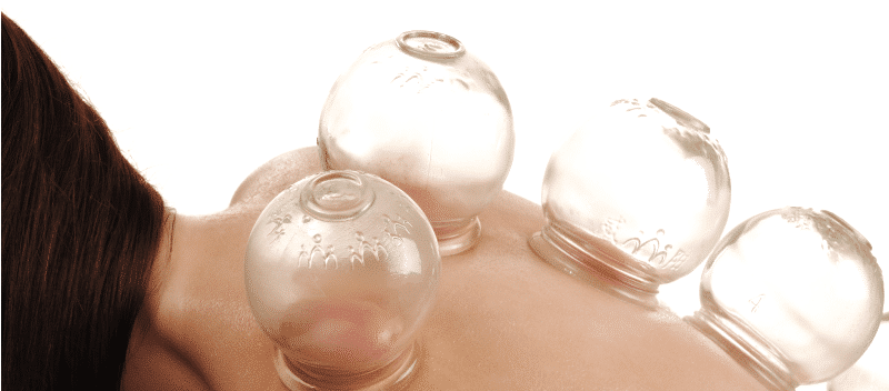 Cupping Therapy Calgary NW